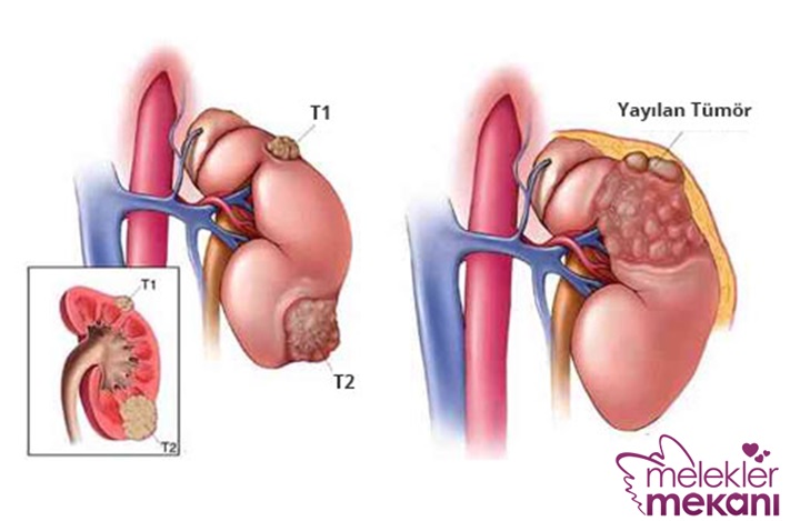 böbrek kanseri.jpg