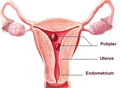 polip-nedir.jpg