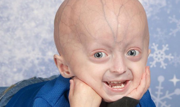 t1larg.progeria.jpg